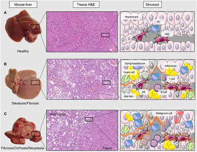 Interplay Between Macrophages and Angiogenesis: A Double-Edged Sword in Liver Disease